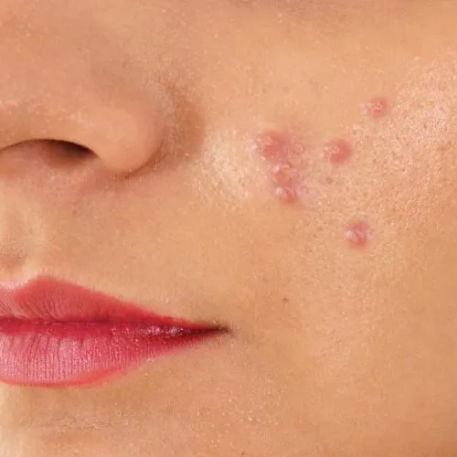 kandungan skincare yang cocok untuk kulit berminyak dan berjerawat