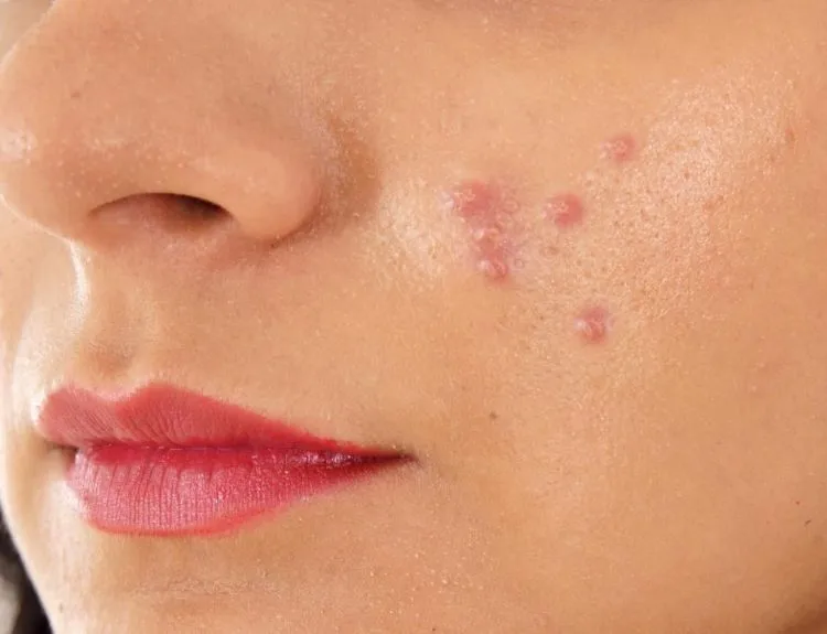 kandungan skincare yang cocok untuk kulit berminyak dan berjerawat