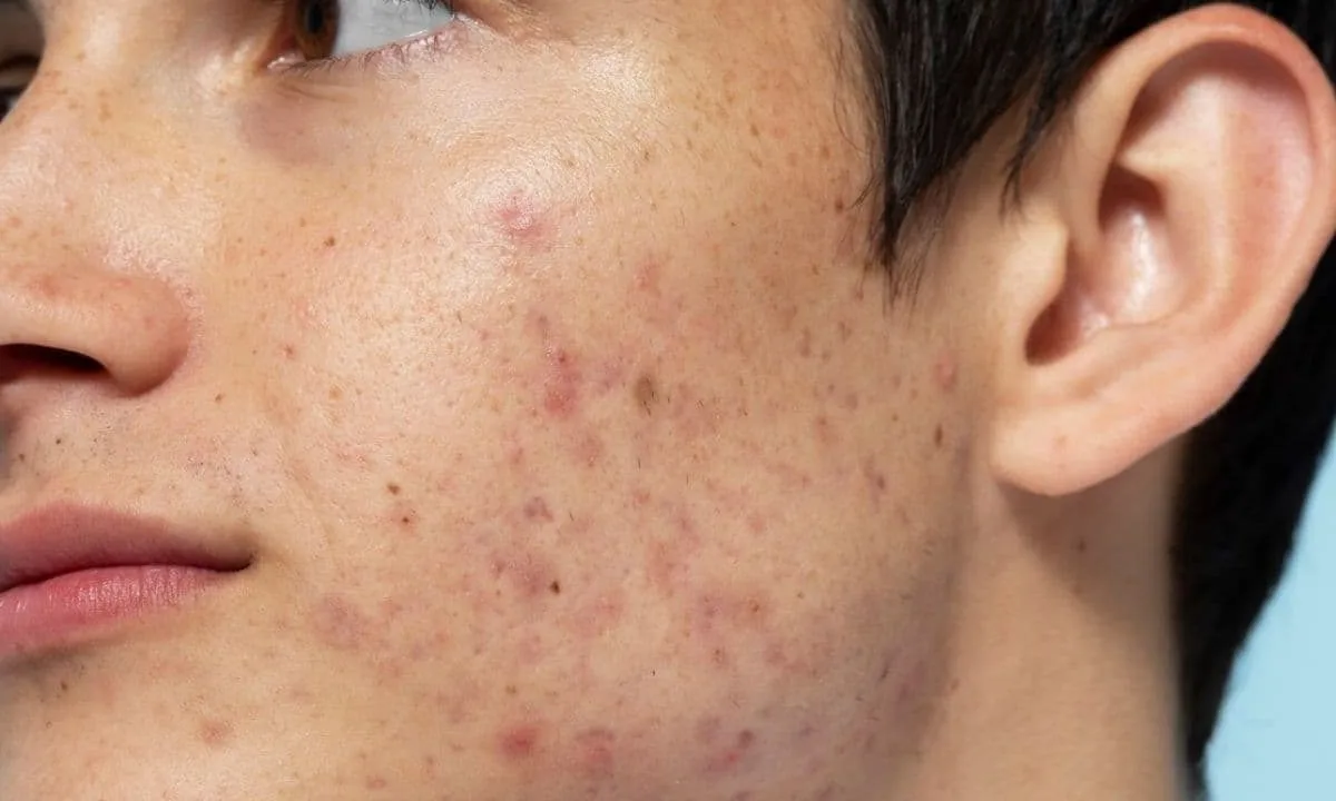 Kulit Terasa Ketat dan Kusam Padahal Baru Pakai Moisturizer? Ini Cara Mengatasi Kulit Dehidrasi yang Bikin Kamu Percaya Diri Lagi
