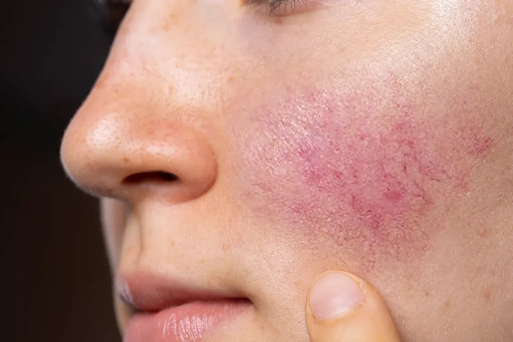 ciri ciri rosacea