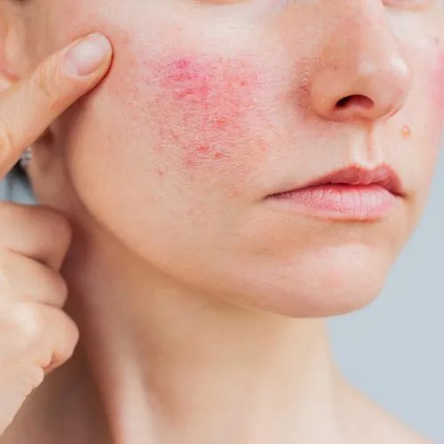 ciri ciri rosacea