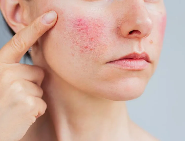 ciri ciri rosacea