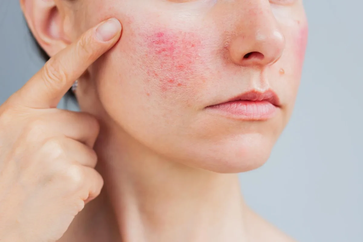 ciri ciri rosacea