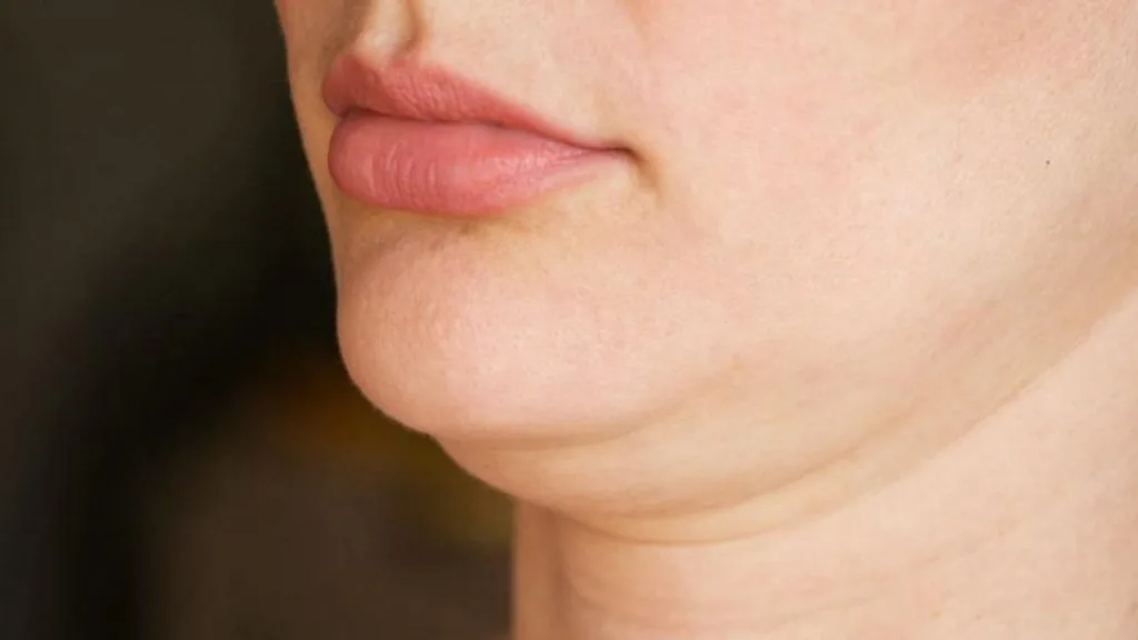 double chin disebabkan oleh