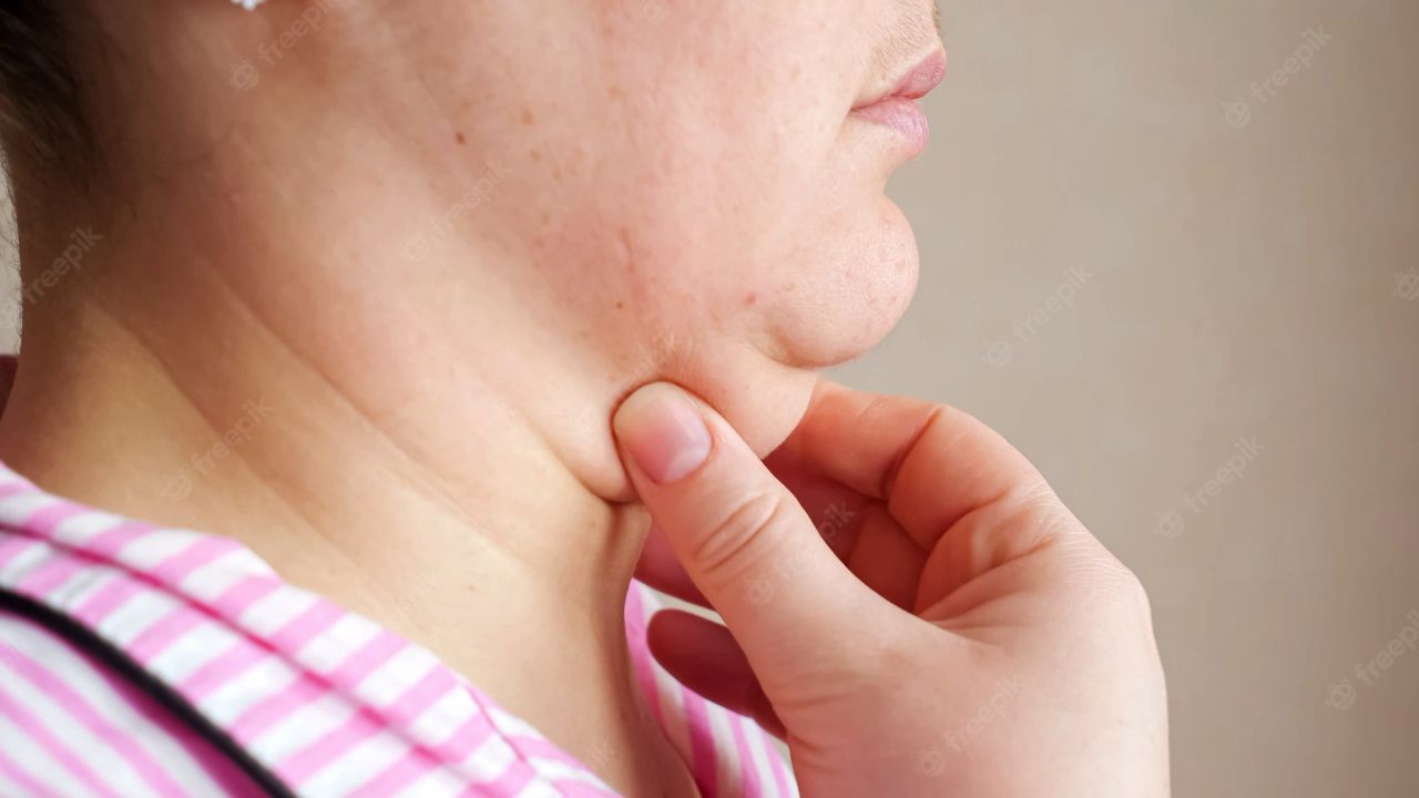 double chin disebabkan oleh