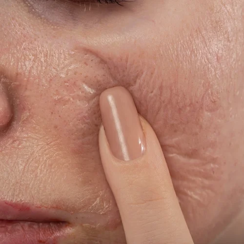 efek chemical peeling