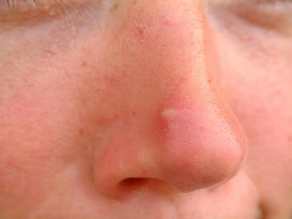 jerawat di hidung luar