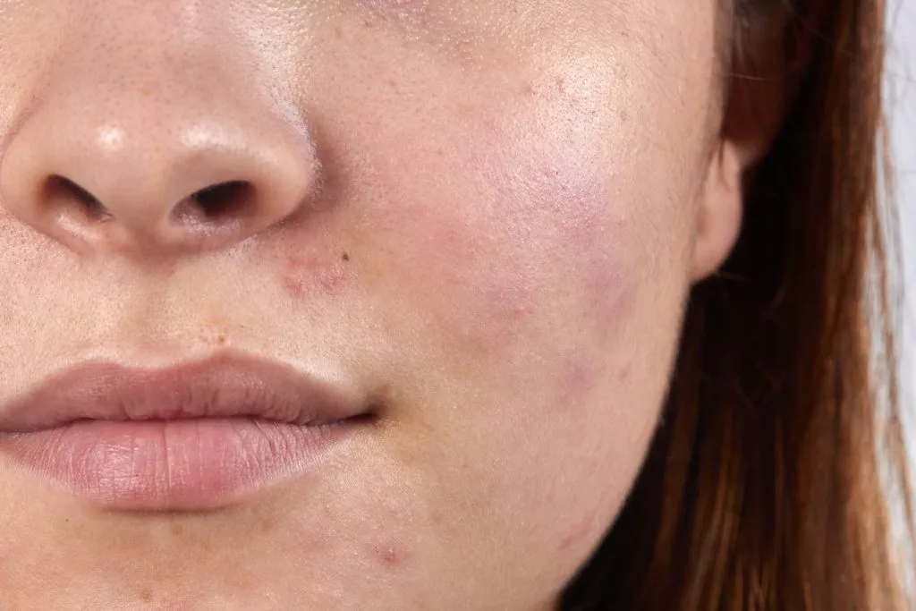 kandungan skincare untuk bekas jerawat pie