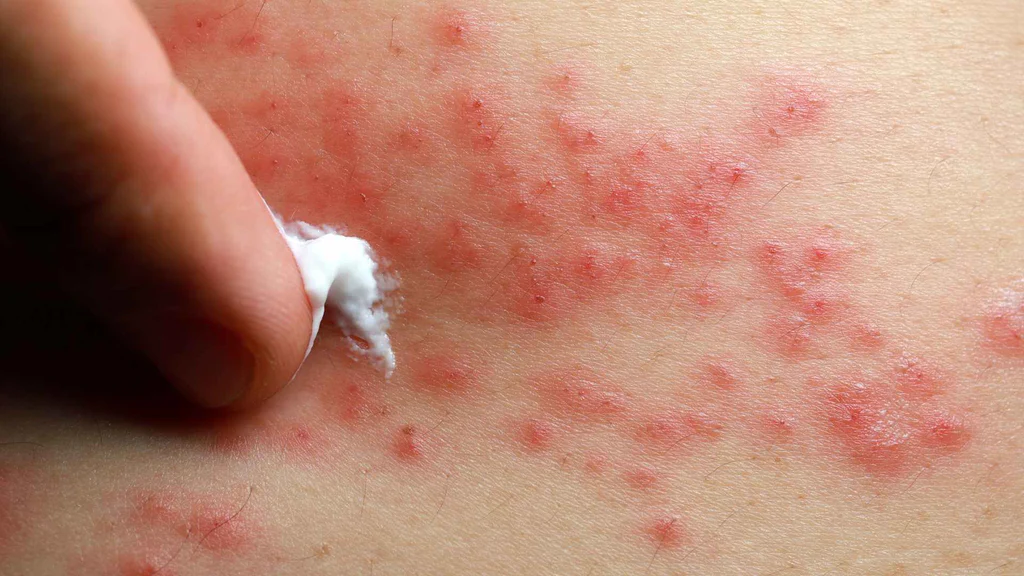 krim kortison atau steroid untuk bekas jerawat