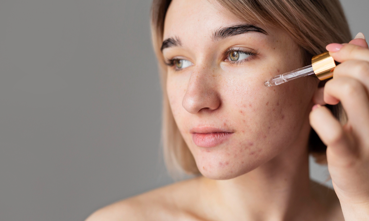 Acne Prone Skin Adalah Kondisi yang Sering Bikin Kamu Frustrasi, Tapi Bisa Diatasi dengan Cara yang Tepat!