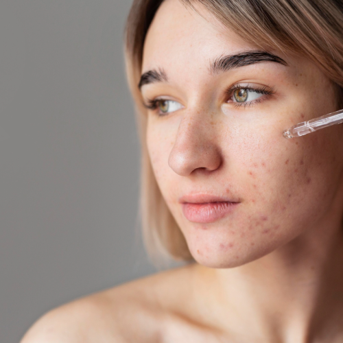 adult acne
