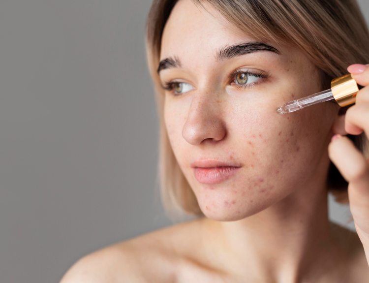 adult acne