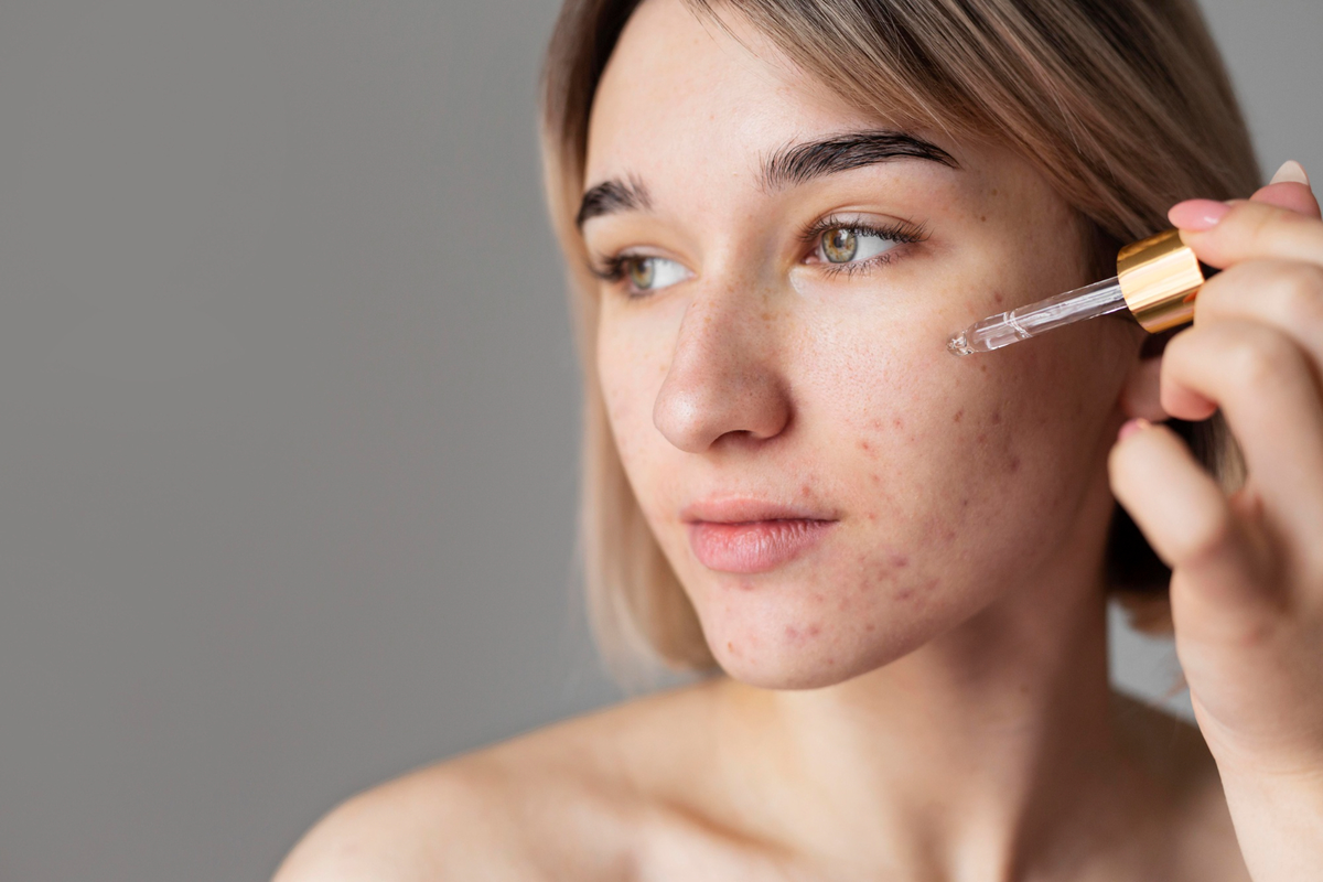 adult acne