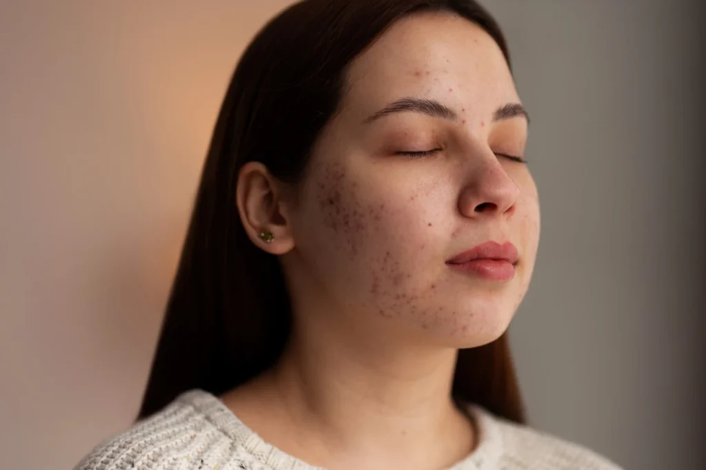 menghilangkan dark spot di wajah