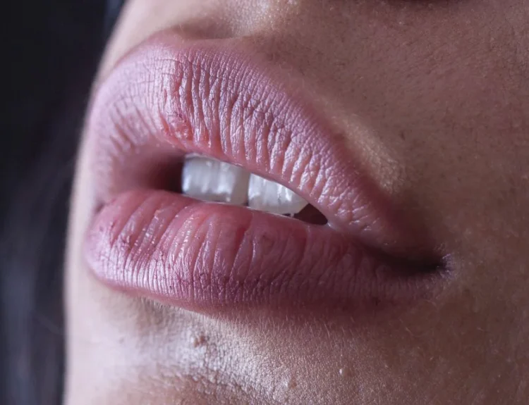 perawatan bibir hitam