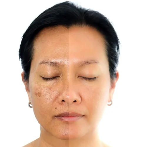 skincare untuk melasma