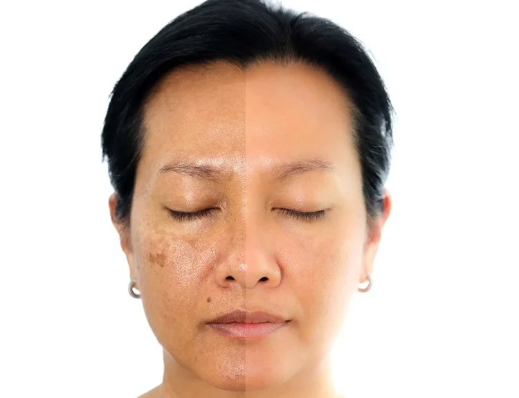 skincare untuk melasma