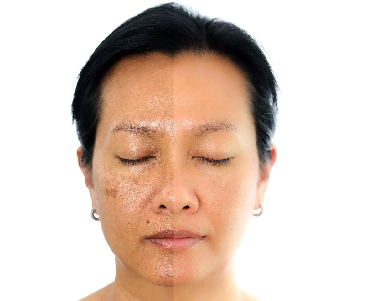 skincare untuk melasma