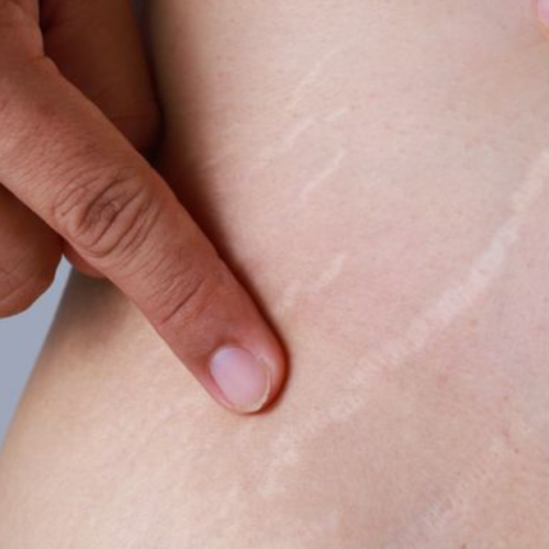 stretch mark di ketiak