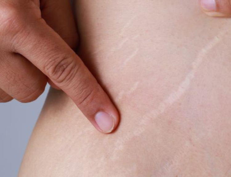 stretch mark di ketiak