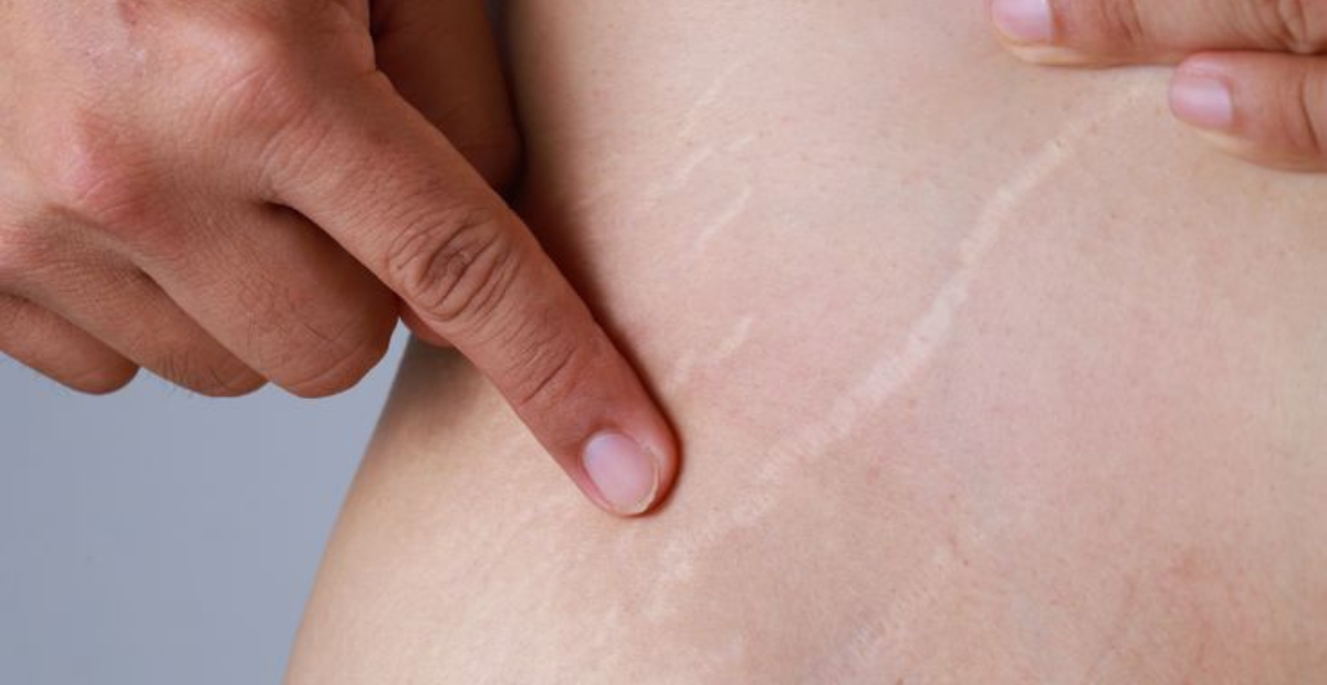 stretch mark di ketiak