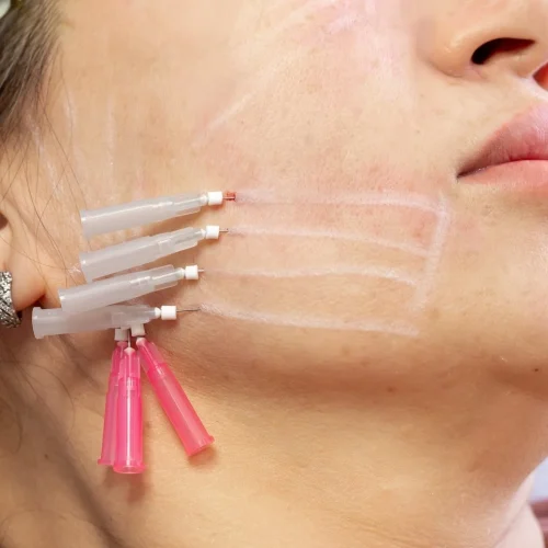 thread lift adalah