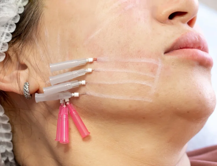 thread lift adalah