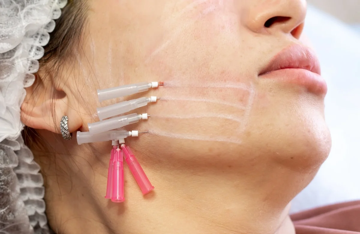 thread lift adalah