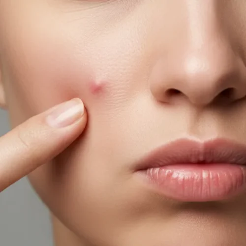cara mengatasi jerawat hormonal