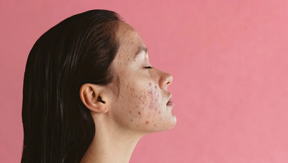 cara mengatasi jerawat hormonal