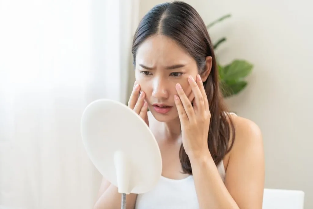 cara menghilangkan melasma di wajah