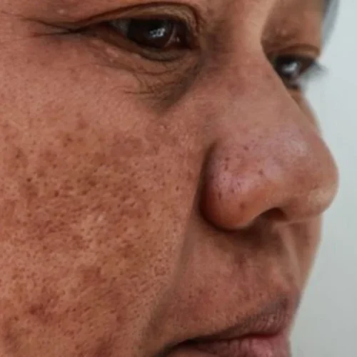 cara menghilangkan melasma di wajah