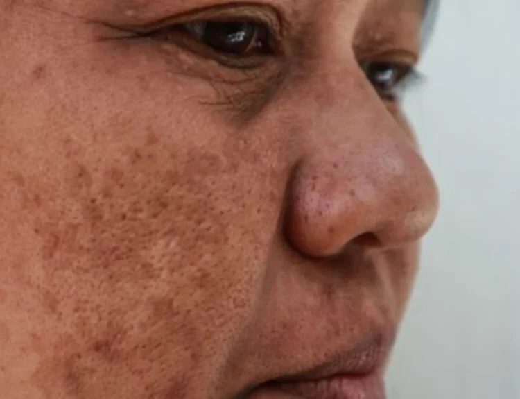 cara menghilangkan melasma di wajah