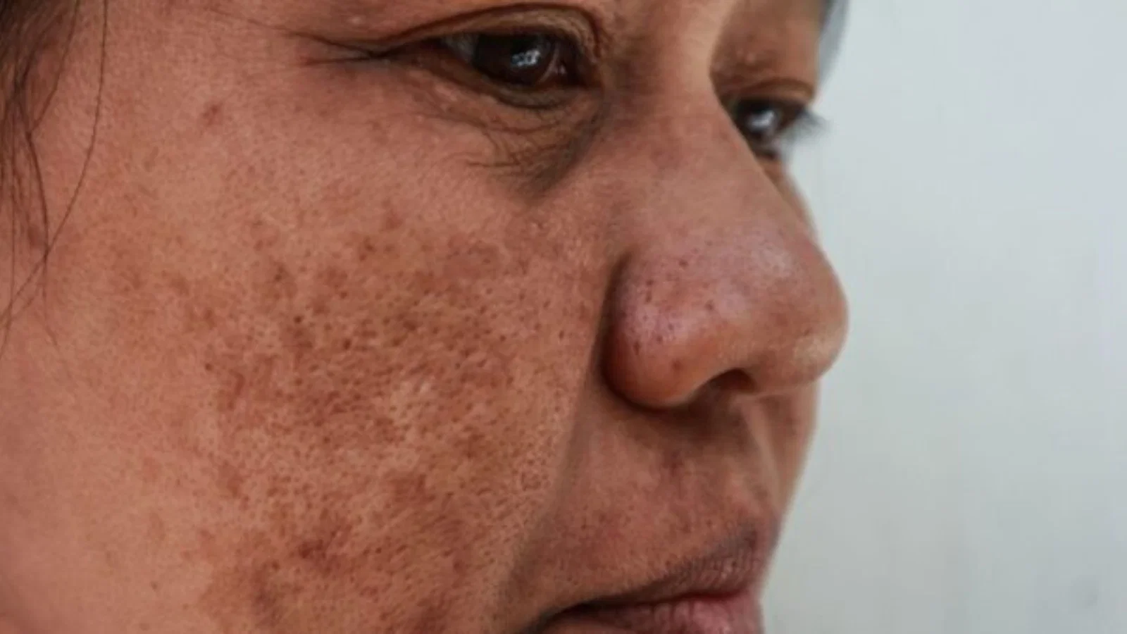 cara menghilangkan melasma di wajah