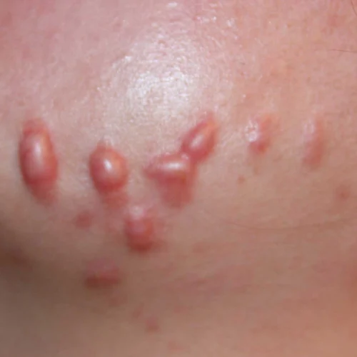 keloid di muka