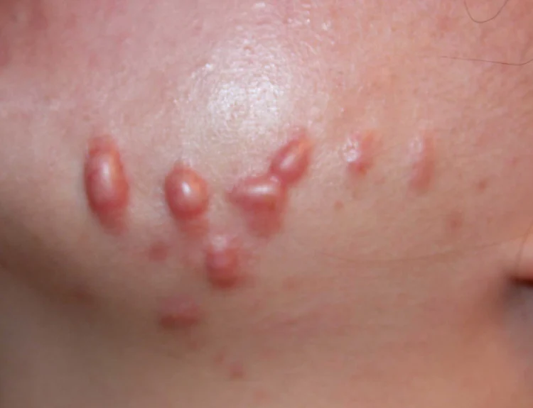 keloid di muka