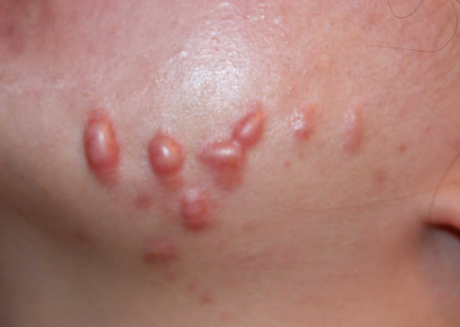 keloid di muka