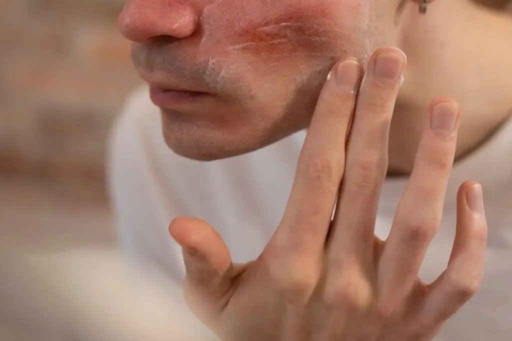 keloid di muka