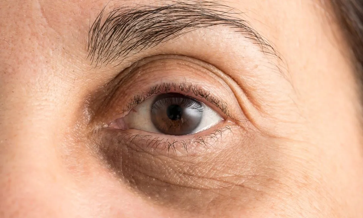 Masih Biarkan Kantung Mata Mengganggu? Coba Eye Treatment yang Bikin Mata Lebih Segar!