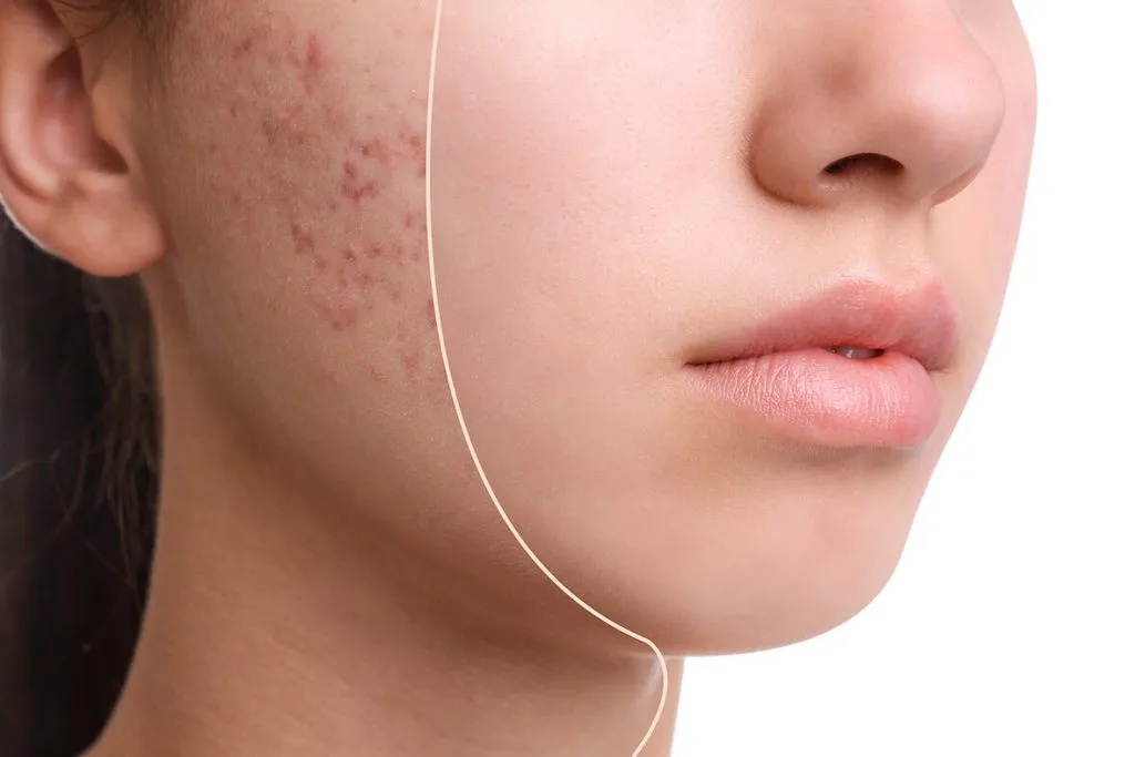 penyebab acne vulgaris