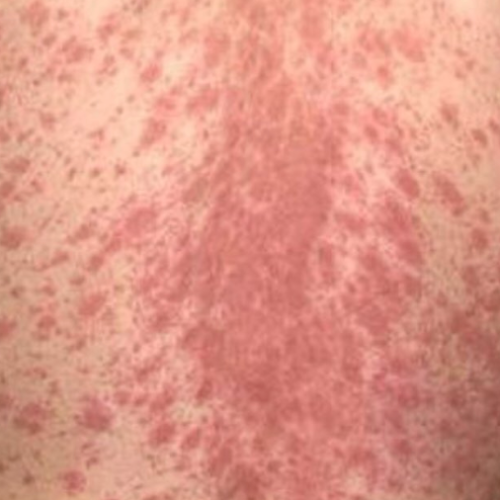 penyebab pityriasis rosea
