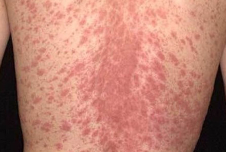 penyebab pityriasis rosea