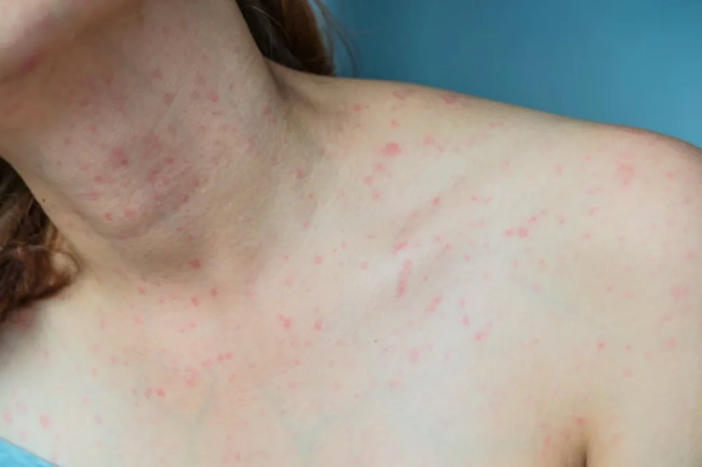 penyebab pityriasis rosea