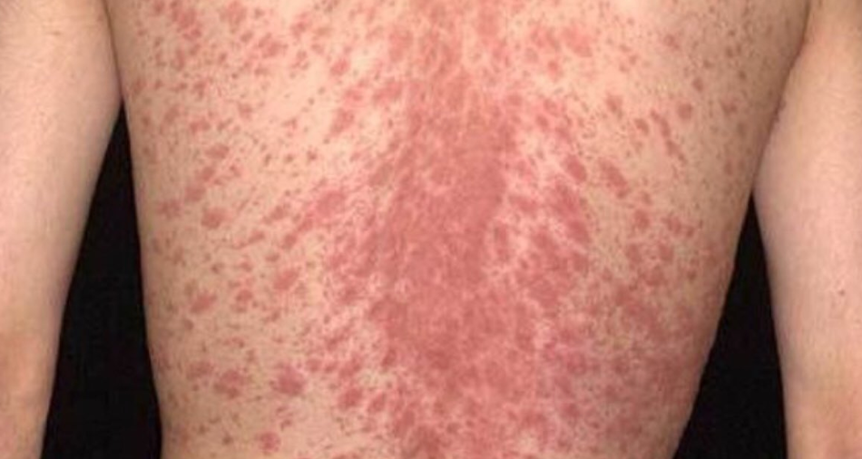 penyebab pityriasis rosea