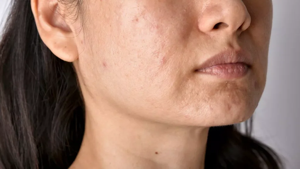 acne prone skin