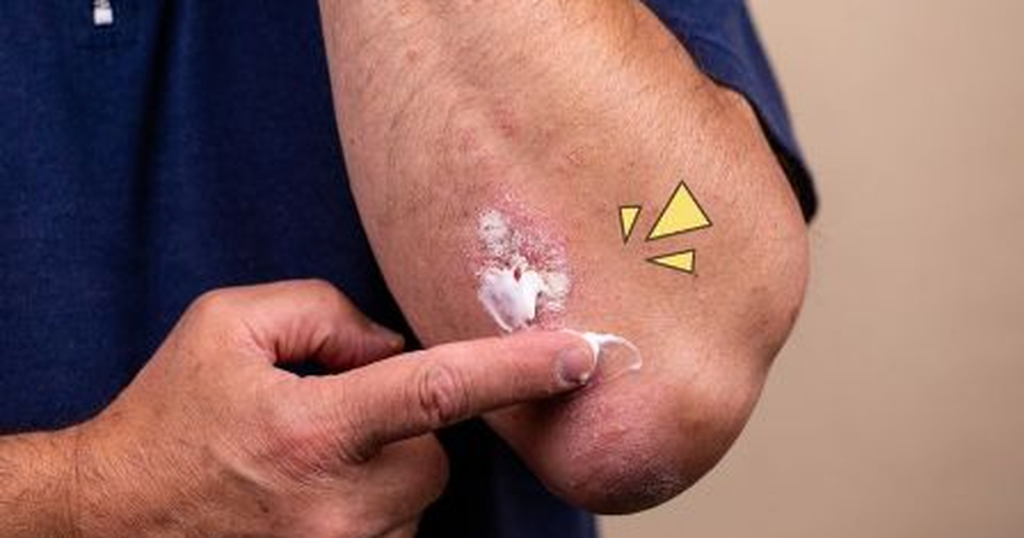 antibiotik untuk gatal