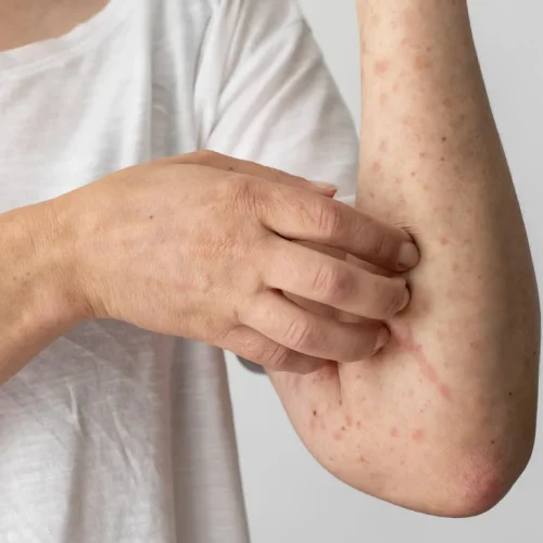 antibiotik untuk gatal