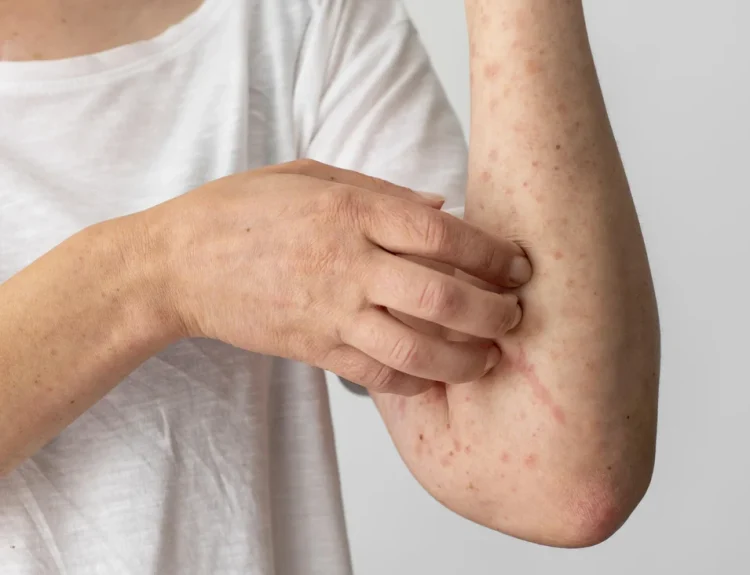 antibiotik untuk gatal