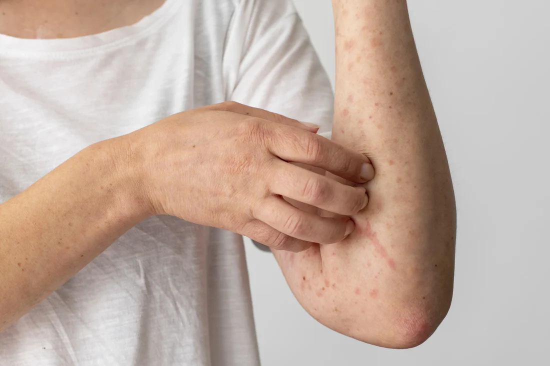 antibiotik untuk gatal