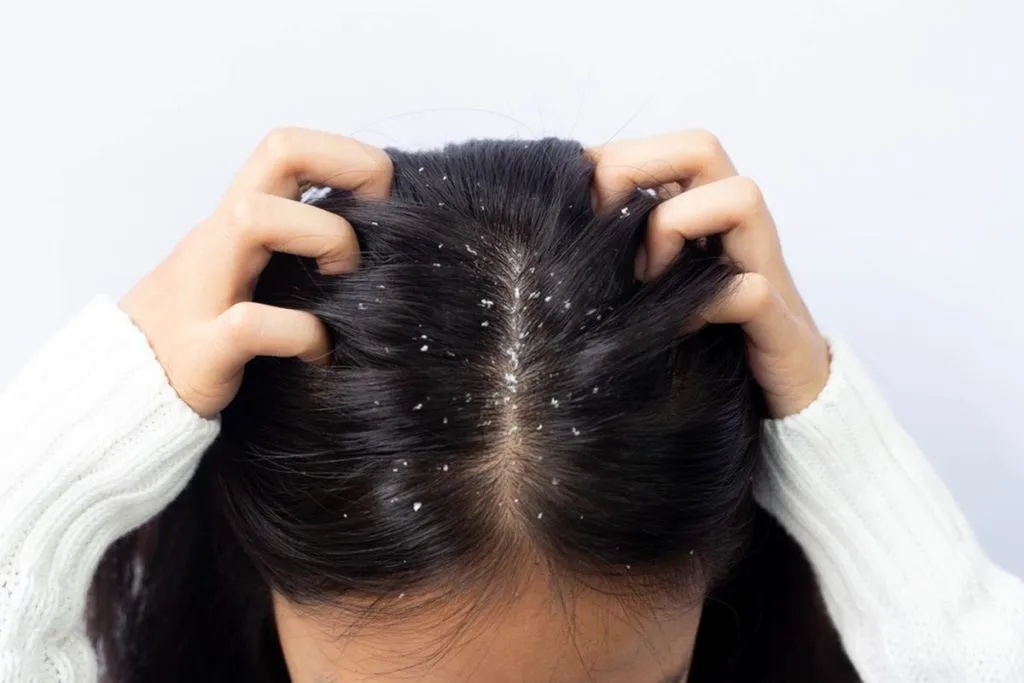 cara mengatasi rambut rontok dan ketombe